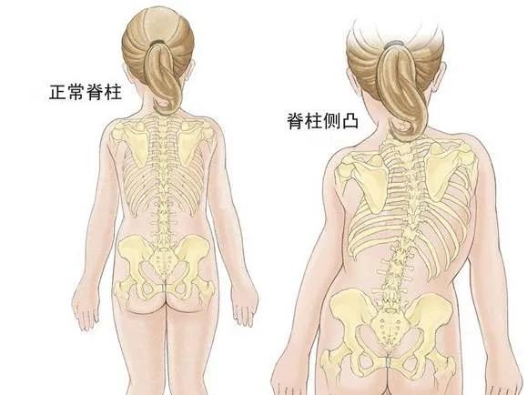 青少年睡姿不對(duì)，真能把脊柱睡“彎”嗎？